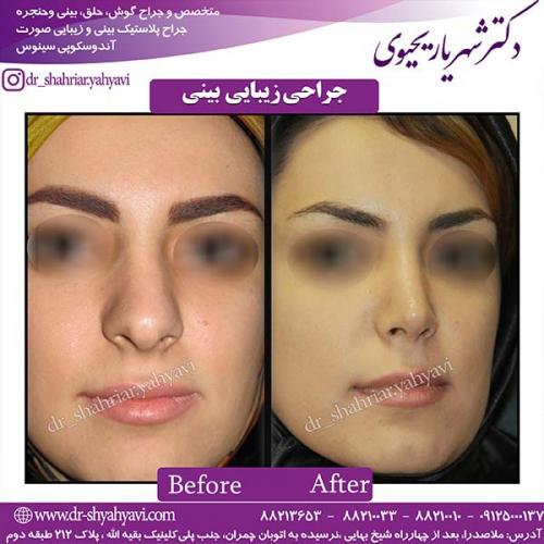 جراحی-بینی-87