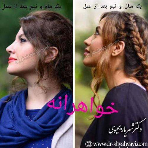 جراحی-بینی-88