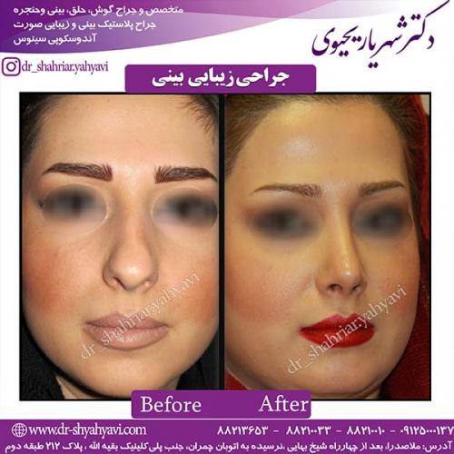 جراحی-بینی-89