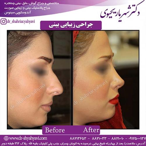 جراحی-بینی-90