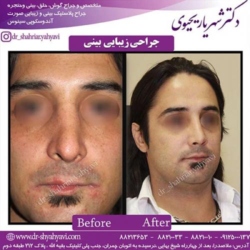 جراحی-بینی-91