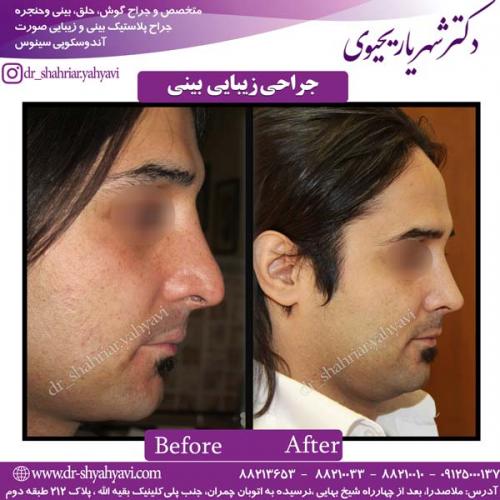جراحی-بینی-92
