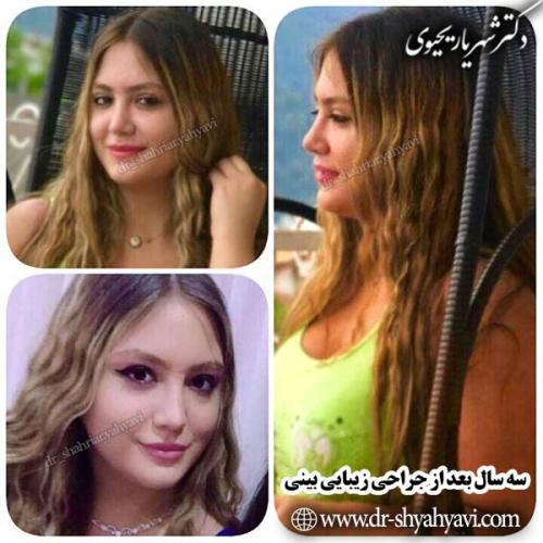 جراحی-بینی-93