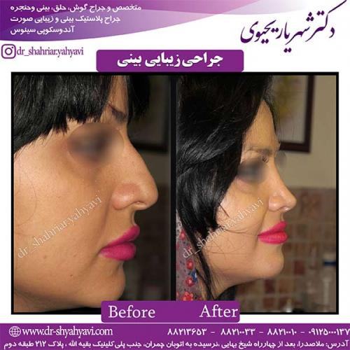 جراحی-بینی-94