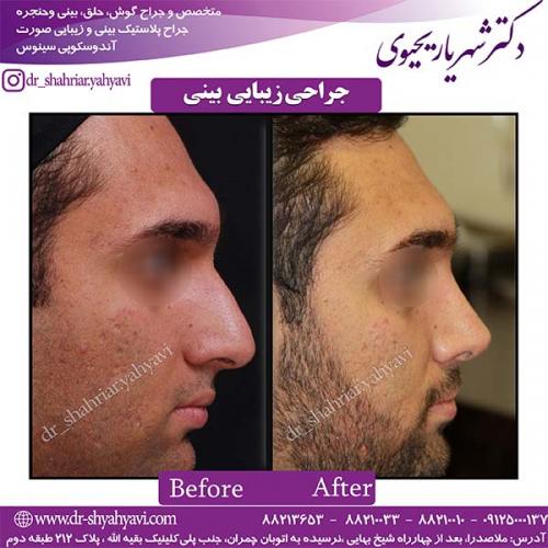 جراحی-بینی-96