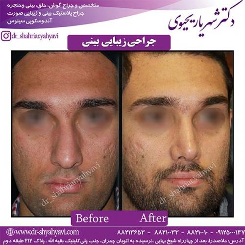 جراحی-بینی-97