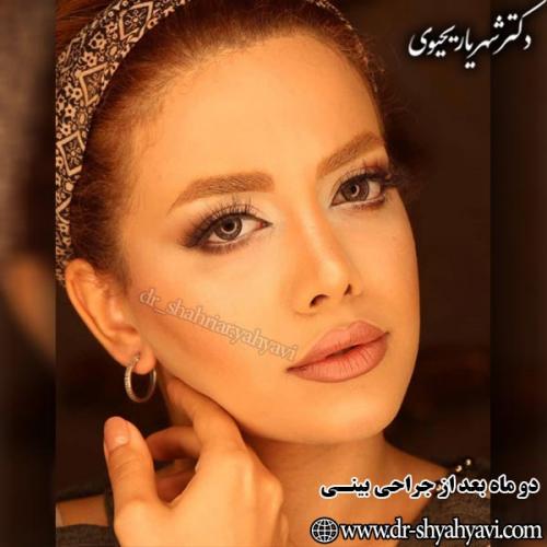 جراحی-بینی-98