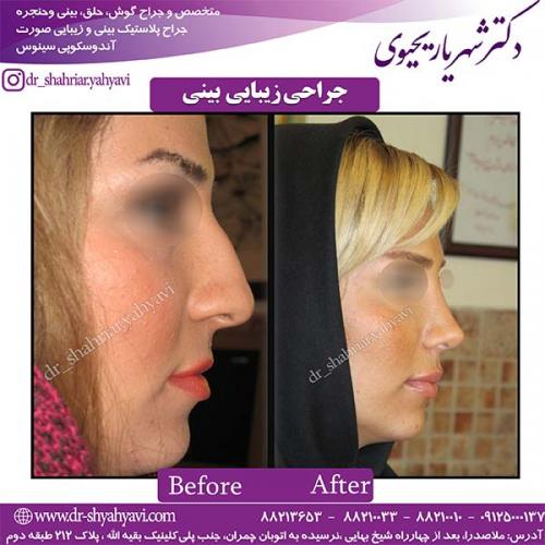 جراحی-بینی-99