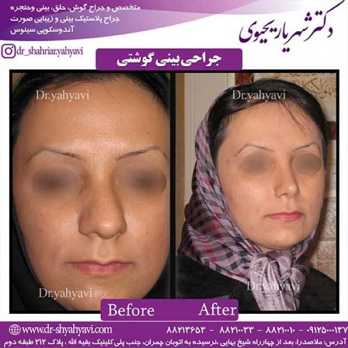 جراحی-بینی-گوشتی