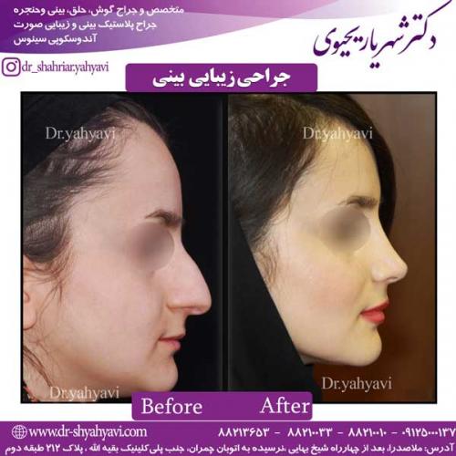 جراحی-زیبایی-بینی-1