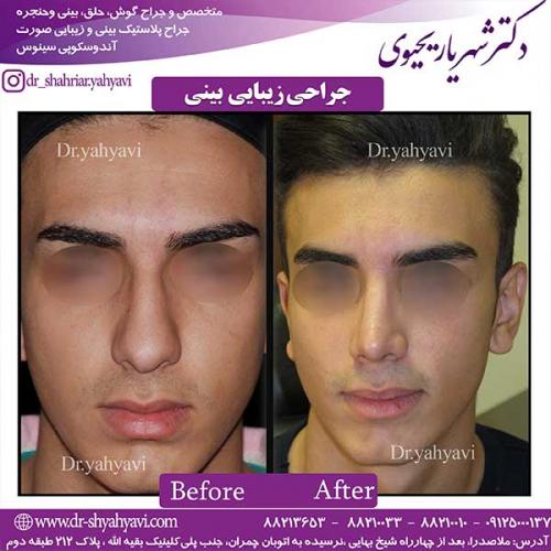جراحی-زیبایی-بینی-10