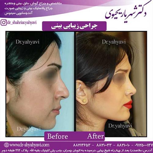 جراحی-زیبایی-بینی-11