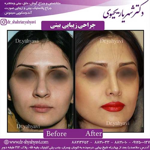 جراحی-زیبایی-بینی-12