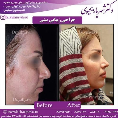 جراحی-زیبایی-بینی-16