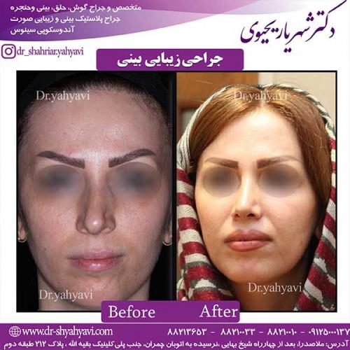 جراحی-زیبایی-بینی-17