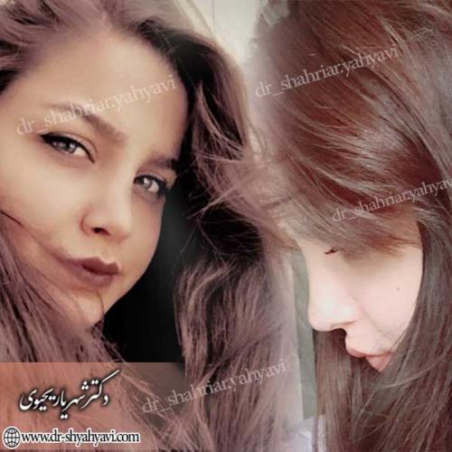 جراحی-زیبایی-بینی-18