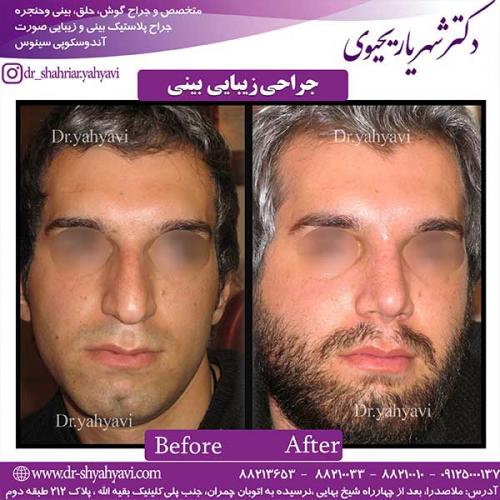 جراحی-زیبایی-بینی-19
