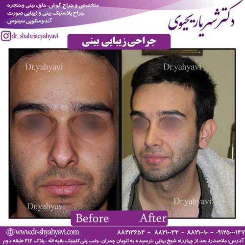 جراحی-زیبایی-بینی-2