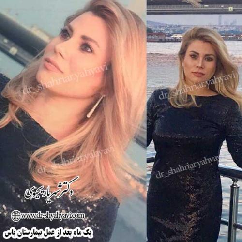 جراحی-زیبایی-بینی-22