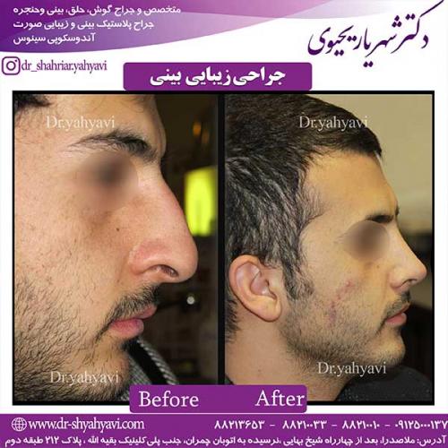 جراحی-زیبایی-بینی-23