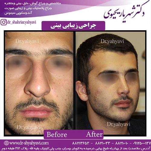 جراحی-زیبایی-بینی-24