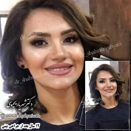 جراحی-زیبایی-بینی-26
