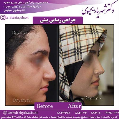 جراحی-زیبایی-بینی-27