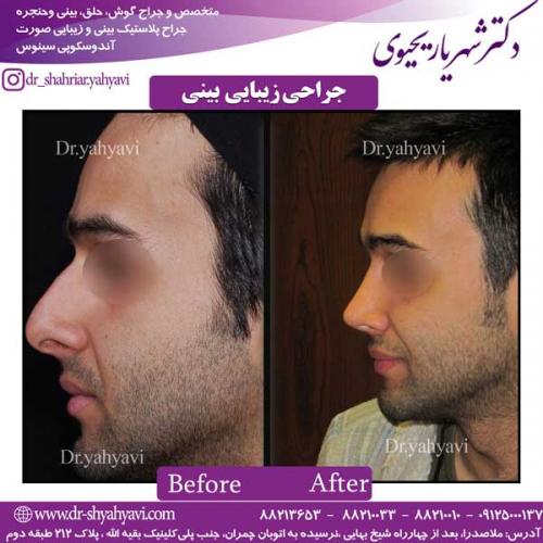 جراحی-زیبایی-بینی-3