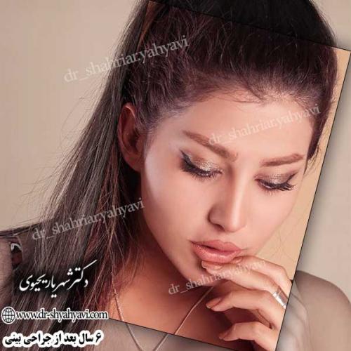 جراحی-زیبایی-بینی-30