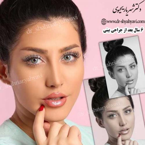 جراحی-زیبایی-بینی-31