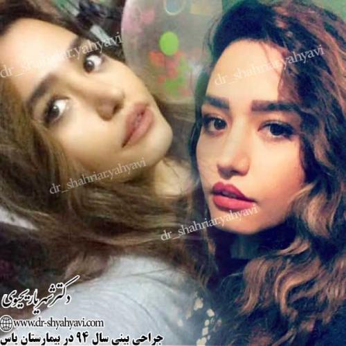 جراحی-زیبایی-بینی-6