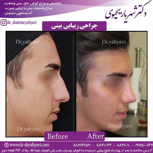 جراحی-زیبایی-بینی-9