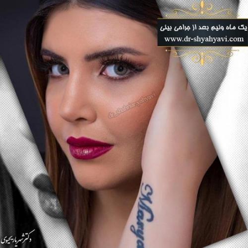 جراحی بینی 185 