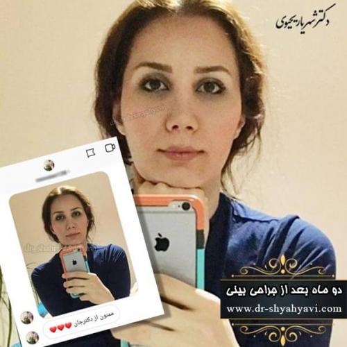 جراحی بینی 186