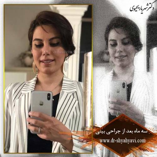 جراحی بینی 187