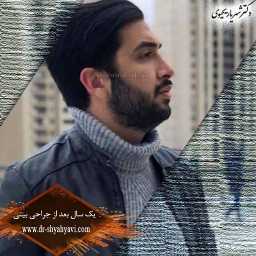 جراحی بینی 188