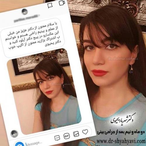 جراحی بینی 189