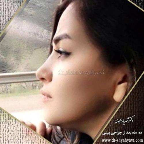 جراحی بینی 190