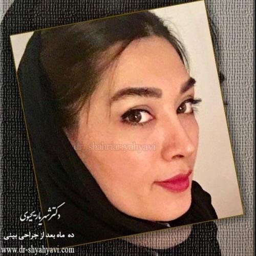 جراحی بینی 191