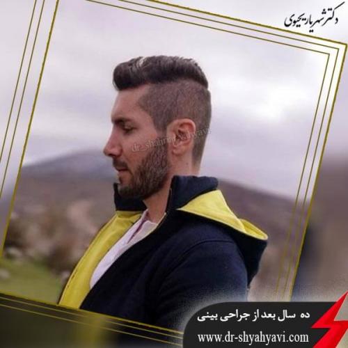 جراحی بینی 193