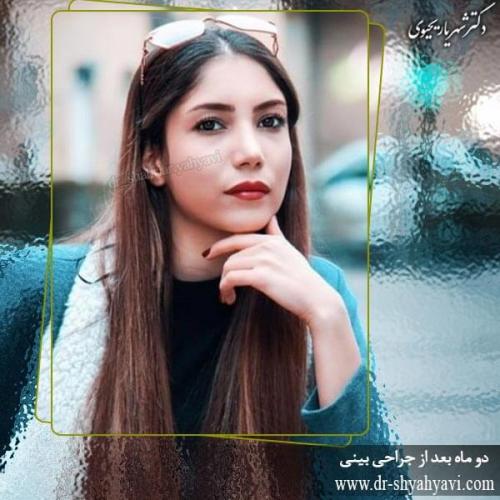 جراحی بینی 194