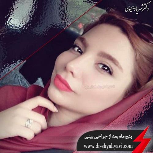 جراحی بینی 195