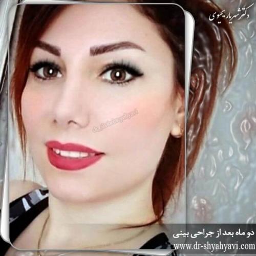 جراحی بینی 199