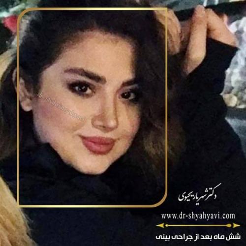 جراحی بینی 200