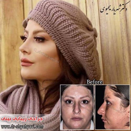 جراحی بینی 204