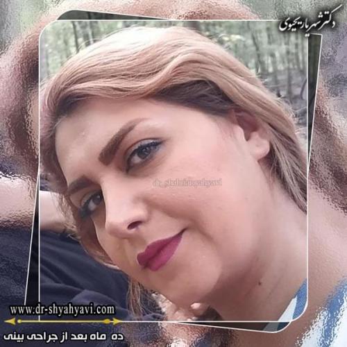 جراحی بینی 205