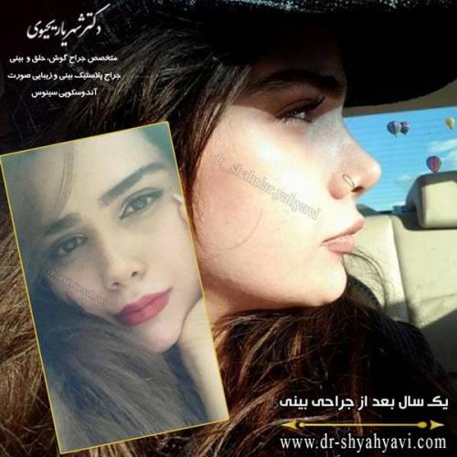 جراحی بینی 207