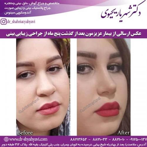 جراحی بینی 211