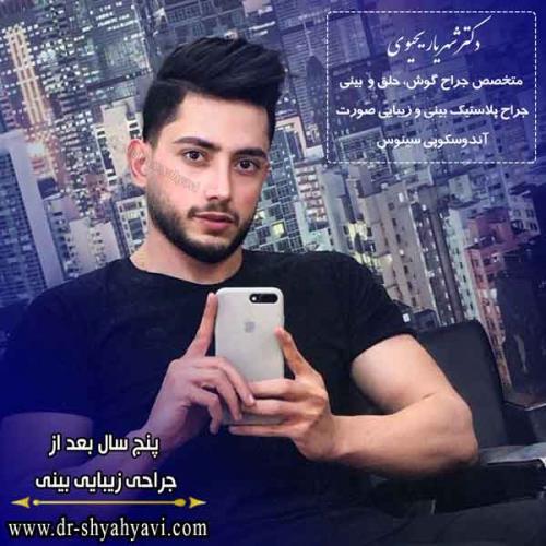 جراحی بینی 215