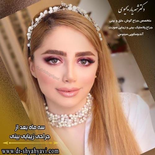 جراحی بینی 216